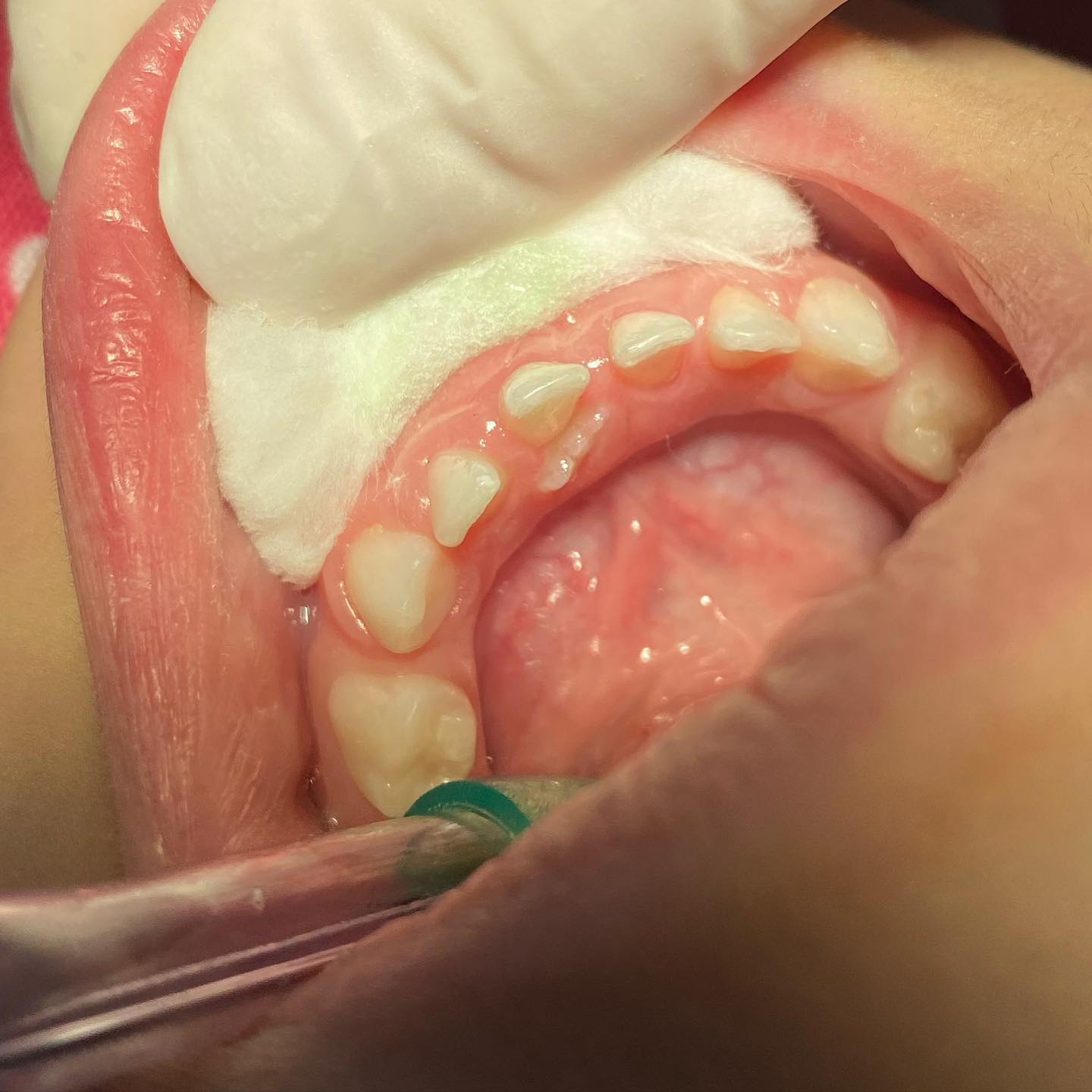 Retenção prolongada do dente de leite